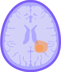 Glioblastoma Multiforme