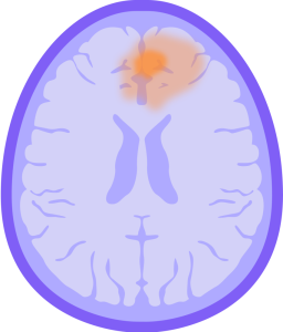 Low Grade Glioma