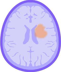 Meningioma
